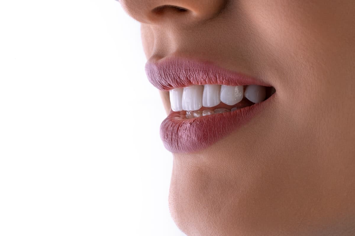 Clareamento dental vale a pena? Tudo o que você precisa saber