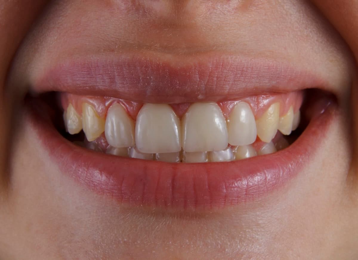 Como clarear dente amarelo: o que funciona de verdade