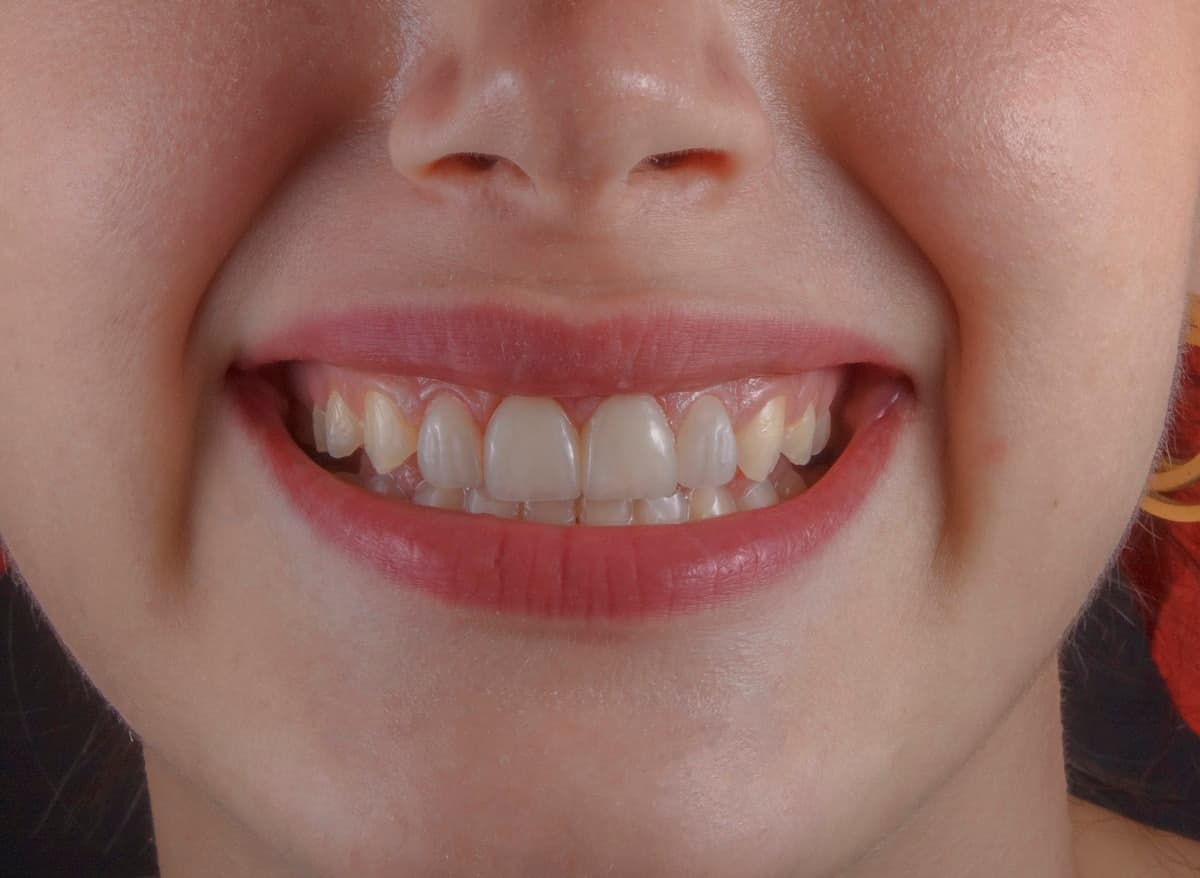 Harmonização do sorriso: o que é (e o que não é)