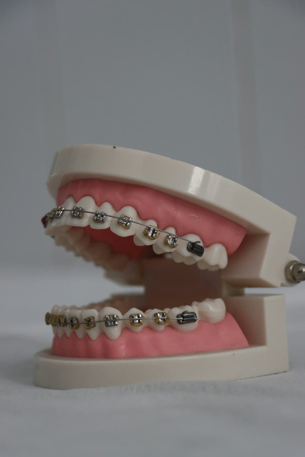 Como higienizar os dentes com aparelho fixo