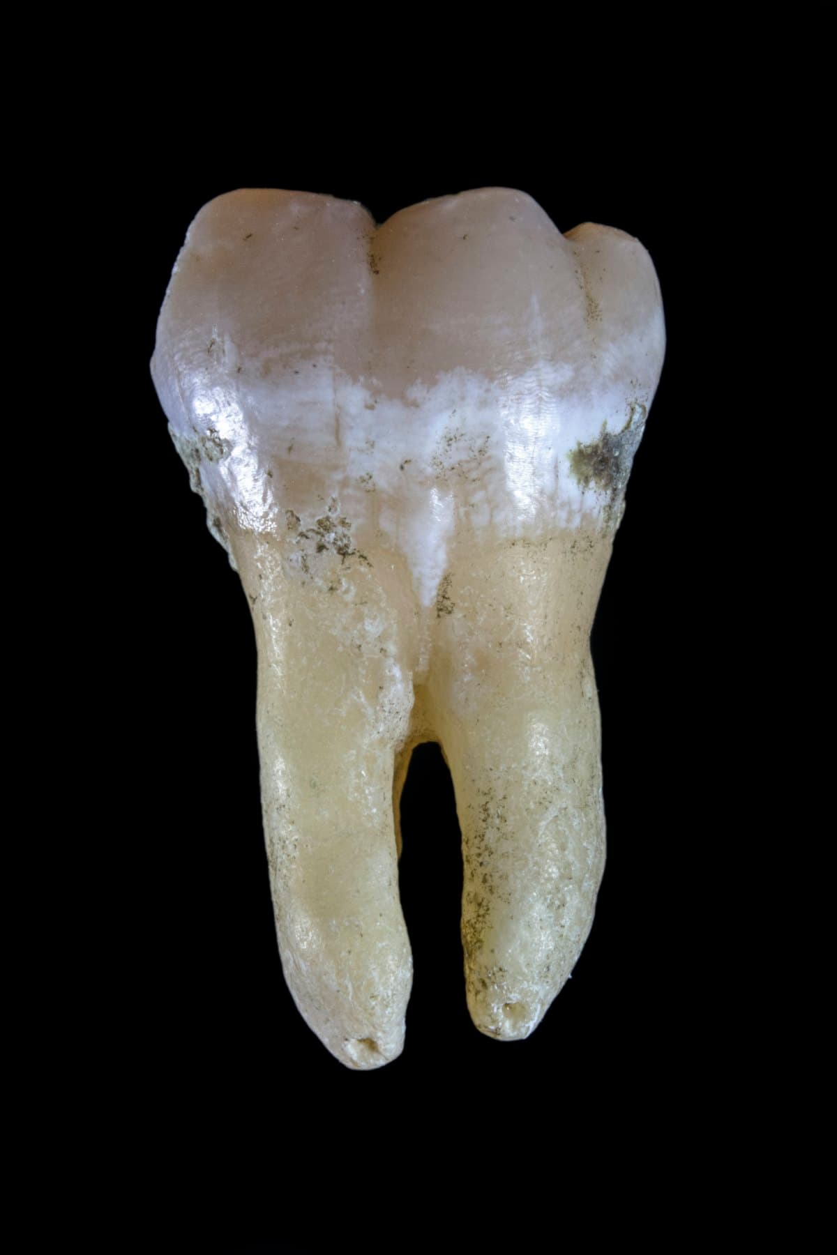 Implante dentário vale a pena? Tudo o que considerar