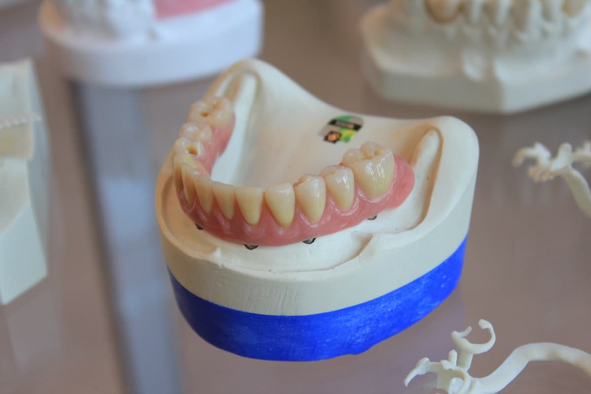 Implante dentário em Juazeiro do Norte: o que considerar