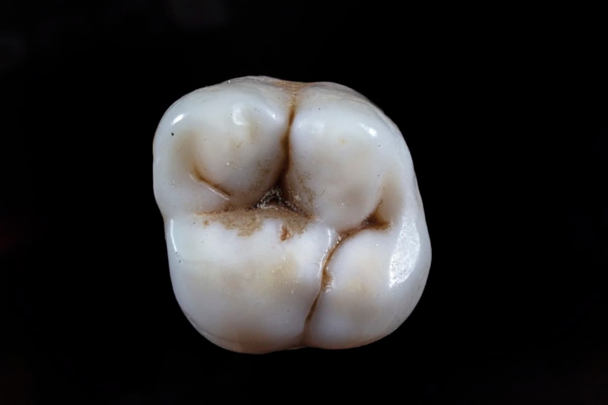 Prótese sobre implante: protocolo, overdenture e coroas