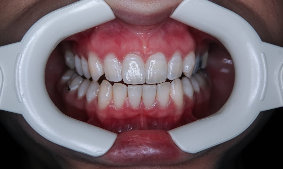 Quanto custa colocar facetas dentais?