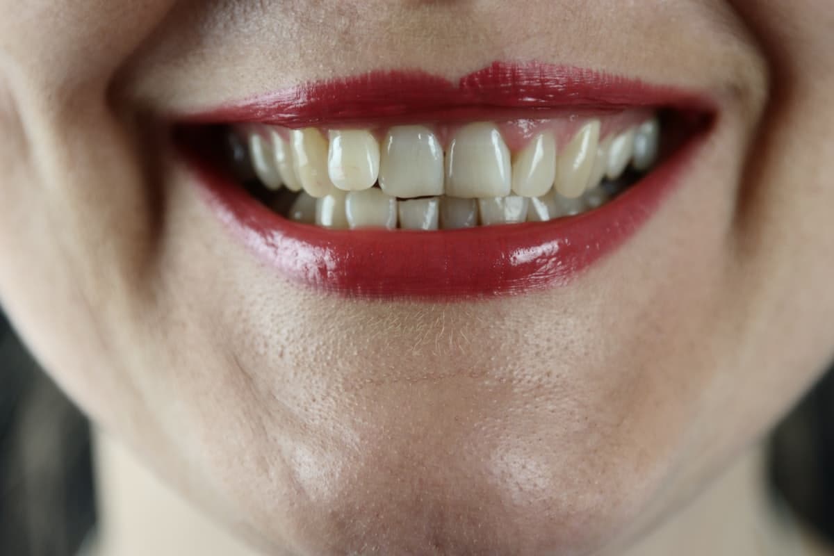 Restauração no dente da frente: como fica natural?