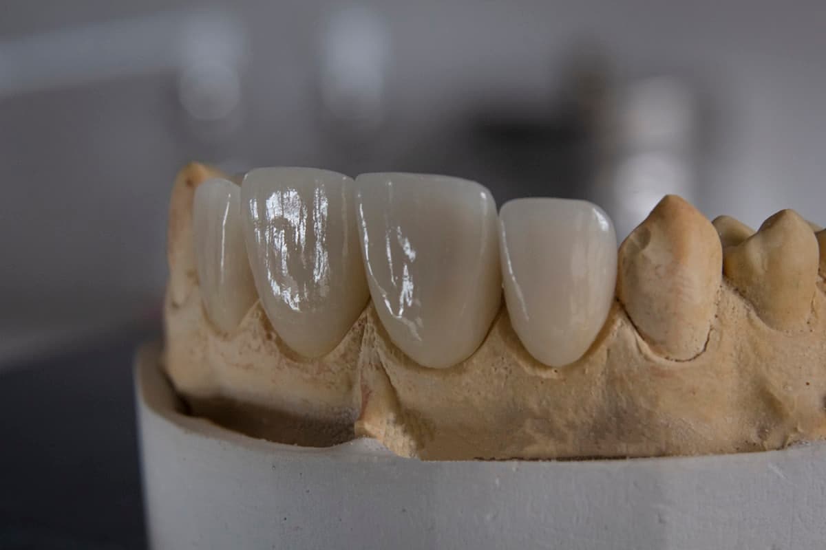Tipos de prótese dentária: qual escolher?